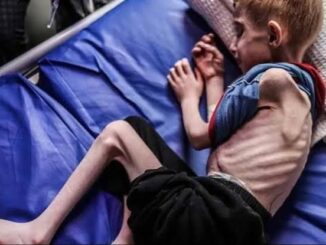 A malnourished child lying on a bed.