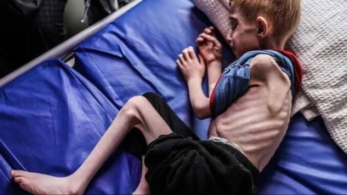 A malnourished child lying on a bed.